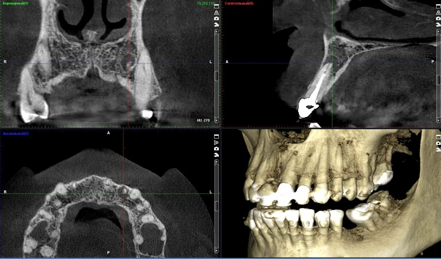 Можно ли с зубным имплантом делать мрт. Кератокиста верхней челюсти кт. КЛКТ зубов верхней челюсти. Мрт Нижний челюсти киста. Фолликулярная киста челюсти снимки.
