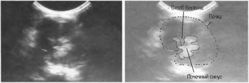 Изменение синусов обеих почек. Почечный синус на УЗИ. Синус почки на УЗИ. Кисты почечного синуса почек.