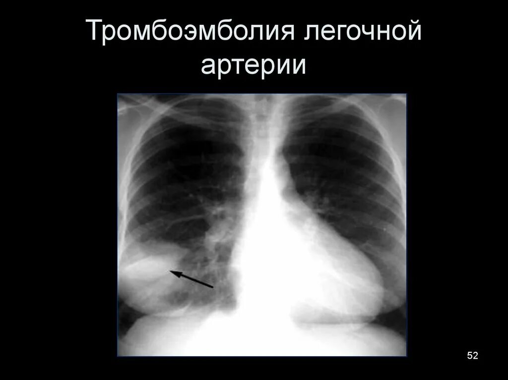 Инфаркт легкого при Тэла рентген. Инфаркт-пневмония легкого рентген. Рентгенодиагностика Тэла. Тромбоэмболия лёгочной артерии симптомы рентген. Тромболия легочной артерии