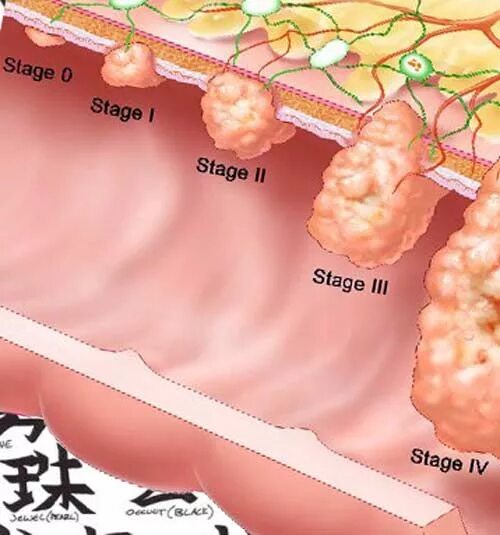 Stages of cancer