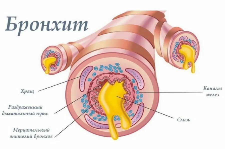 Бронхит бронхи. Бронзитит.