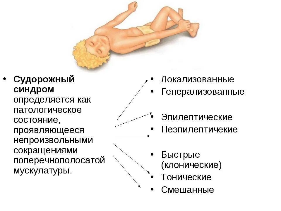 Классификация судорог у детей. Эпилепсия судорожный синдром. Клинические проявления судорожного синдрома. Клонические судороги новорожденных.