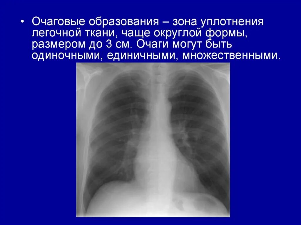 Очаговое уплотнение легочной ткани на кт. Очаговые образования в легких. Очаговое образование в левом легком. Очаговые образования легкие. Образование левой доли легкого