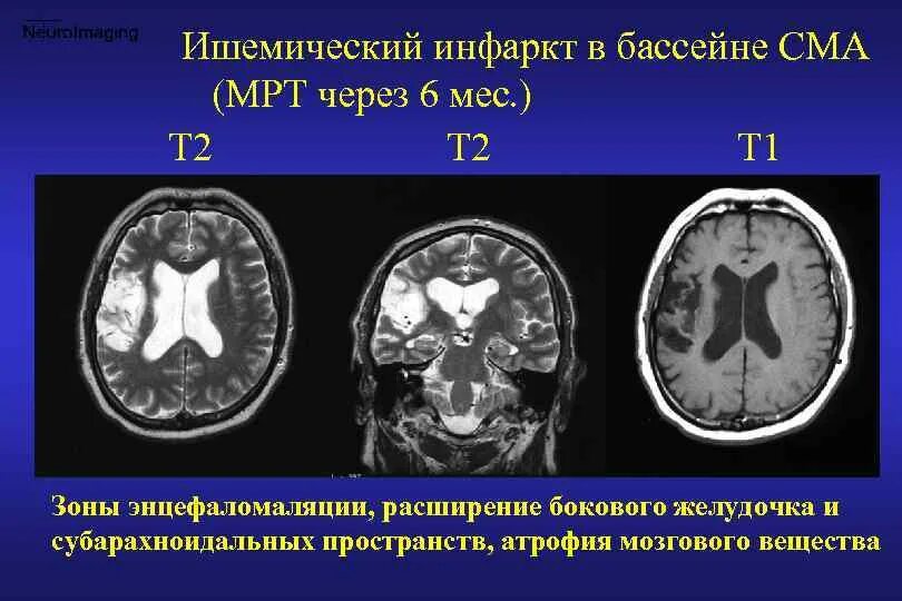 Онмк в бассейне сма. Ишемический инсульт в бассейне сма. инфаркт в бассейне средней мозговой артерии. инфаркт мозга в бассейне сма. мультикистозная энцефаломаляция головного мозга.
