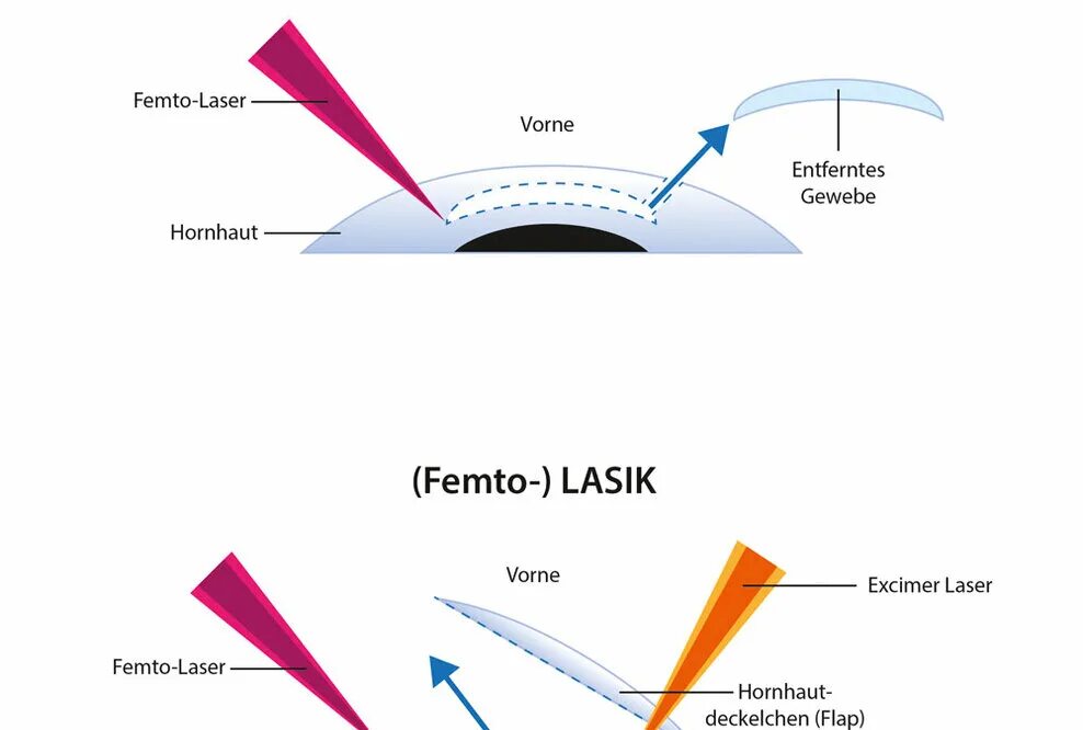 Лазерная коррекция зрения Femto ласик. Фемто ласик этапы операции. Femto super LASIK прибор. RELEX smile лазерная коррекция зрения.