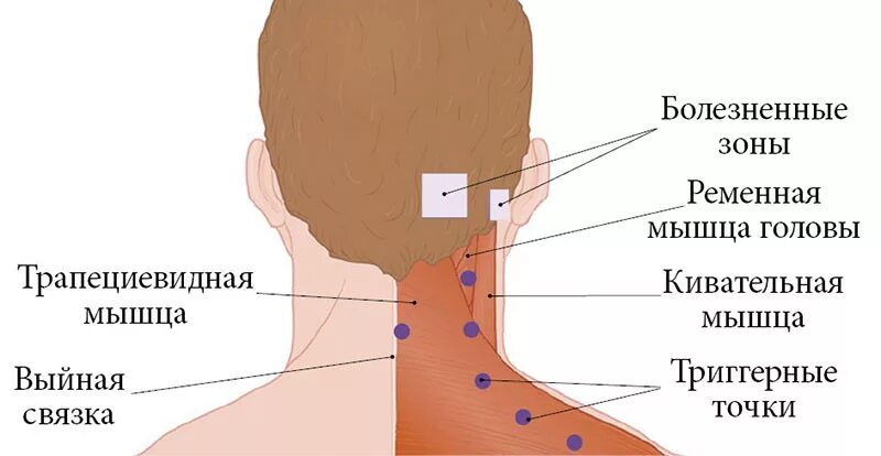 Твердый затылок. Затылок это где. Точки на затылке головы.