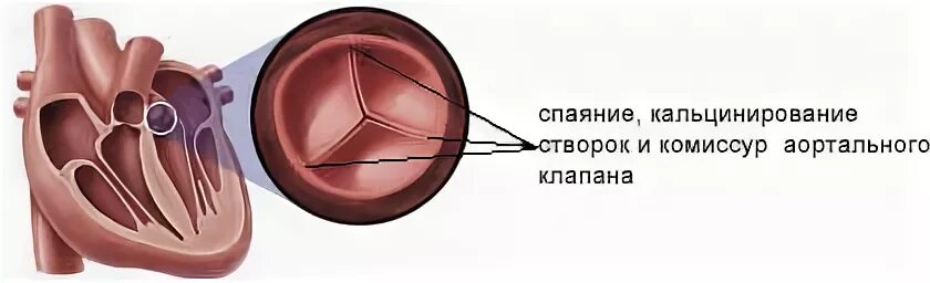 Кальциноз митрального клапана. Кальцинат аортального клапана. Кальцинаты створок аортального клапана. Кальциноз аортальный клапан сердца. Кальцинирование створок клапанов сердца.