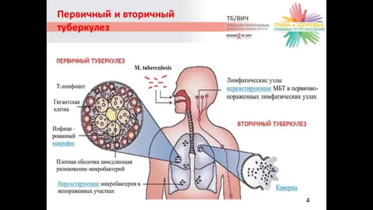 Крым туберкулез