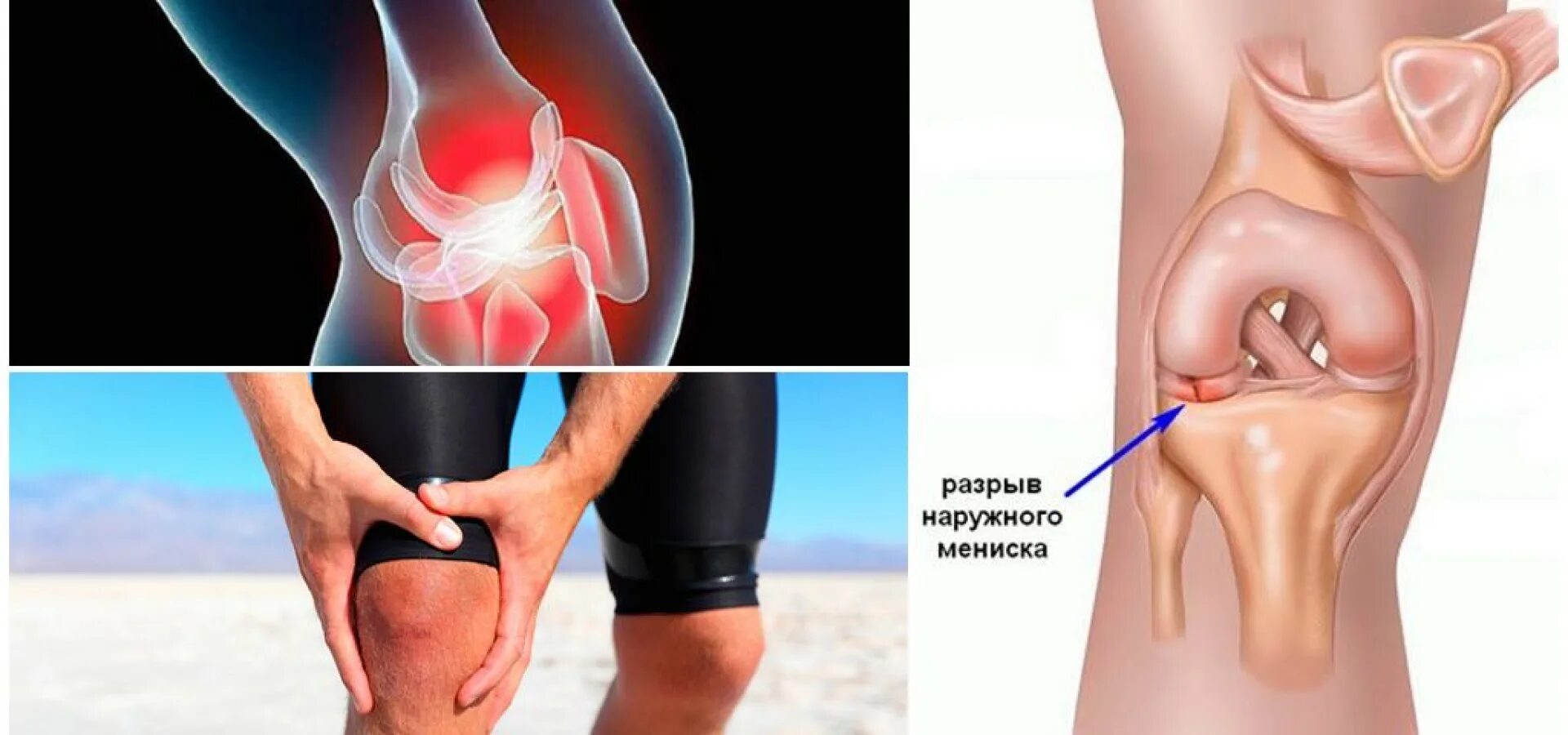 Поврежденный мениск коленного сустава. Разрыв мениска коленного. Разрыв мениска коленного сустава. Разрыв коленого сустава Менис. Менископатия коленного сустава.