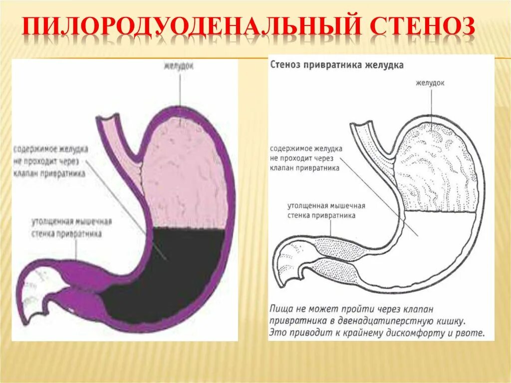 Осложнения стеноза