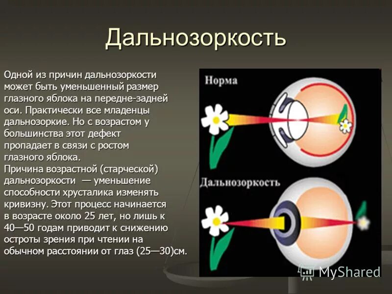 Дальнозоркость что делать. Дальнозоркость. Строение глаза дальнозоркость. Причины дальнозоркости. Дальнозоркость глазами человека.