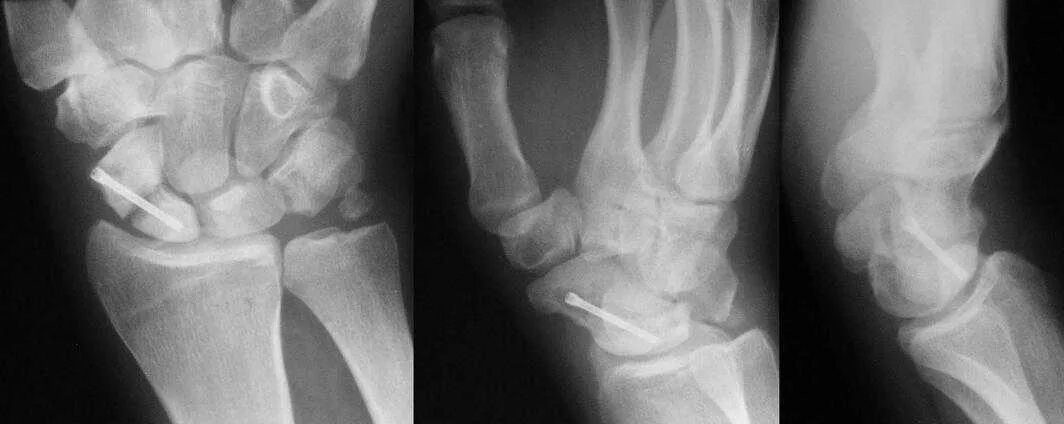 Лечение переломов костей запястья. Несросшийся перелом ладьевидной кости. Перелом гороховидной кости запястья рентген. Несросшийся перелом ладьевидной кости. Асептический некроз ладьевидной кости.
