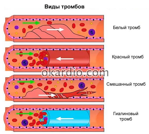 Состав тромба. Строение красного тромба.