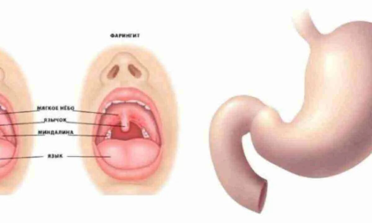 Боль в горле при глотании. Проглотил не в то горло. Ребенок проглотил металлический предмет. Дисфагия 3. Попадание пищи в дыхательные пути.
