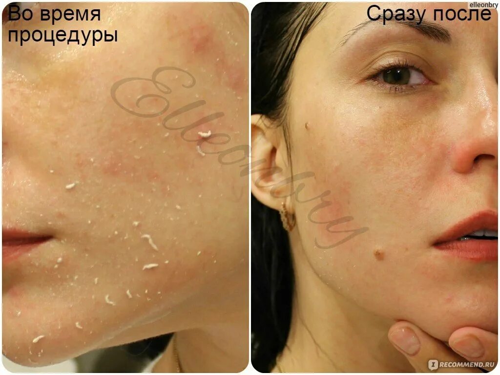 Пилинг New face с фруктовыми кислотами. Пилинг кислотный после процедуры
