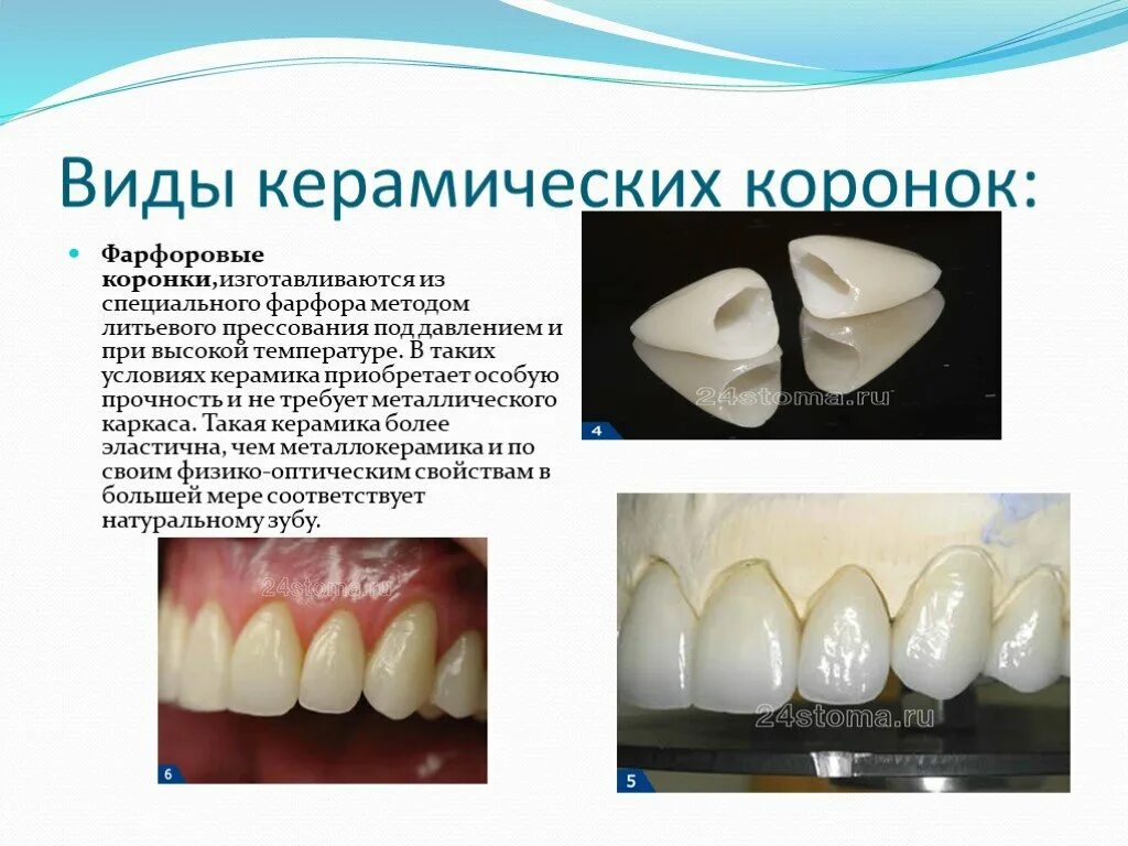 Как долго изготавливается. Фарфоровые коронки клинико лабораторные. Изготовление фарфоровой коронки методом прессования. Коронки из прессованной керамики. Коронки металлокерамика фарфоровая.