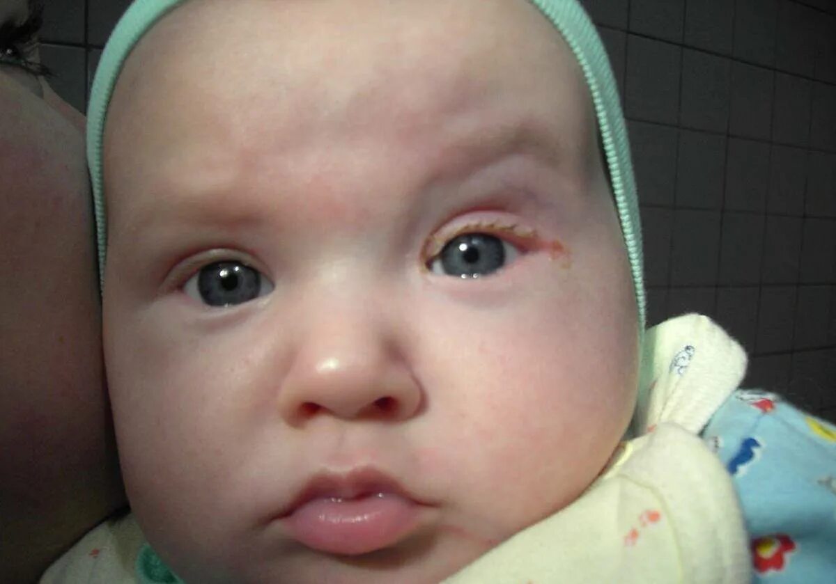 Профилактика глаз новорожденного. Дакриоцистит новорожденных дакриоцистит. Дакриоцистит новорожденных тетрациклиновая. Дакриоцистит новорожденных Офтальма. Флегмонозный острый дакриоцистит.