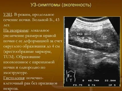 Эхогенность образований на узи