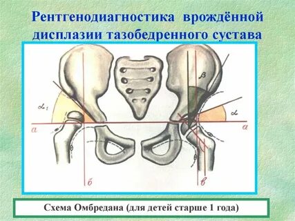 Операция тазобедренного сустава у детей