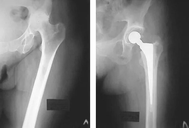 Мрт после эндопротезирования. Однополюсной эндопротез ТБС. Эндопротез бедренной кости. Однополюсное эндопротезирование тазобедренного сустава рентген. Эндопротез головки бедренной кости.