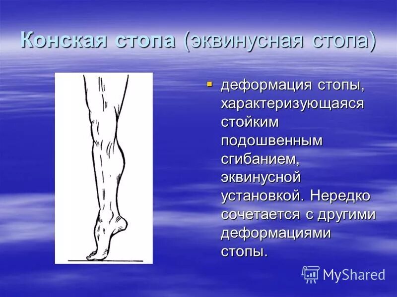 Хождение на носочках. Эквинусное положение стопы в гипсе. Стопа в эквинусном положении. Эквиноварусная деформация стопы рентген. Эквинусная контрактура.
