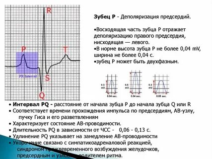Деполяризация предсердий