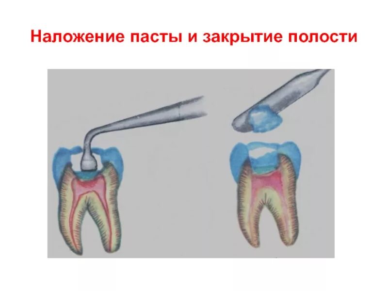 После наложения мышьяка. Методика наложения девитализирующей пасты. пульпит девитализация. этапы наложения мышьяковистой пасты. схема наложения мышьяковистой пасты.