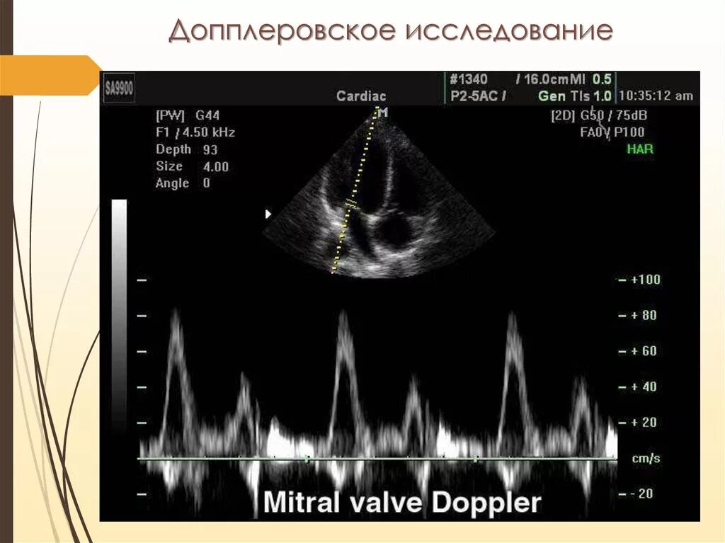 Доплер кровотоки. Митральный стеноз эхокардиография. Митральная недостаточность доплер эхокардиография. Аортальный стеноз допплер ЭХОКГ. Допплер ЭХОКГ при митральной недостаточности.