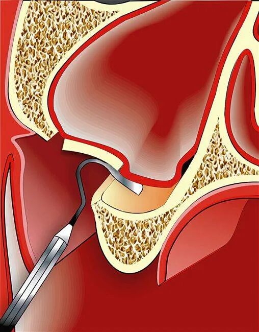 Синус-лифтинг гайморова пазуха. Синус-лифтинг (костная пластика, остеопластика) закрытый. Операция открытый синус лифтинг. Гайморова синус лифтинг открытый.