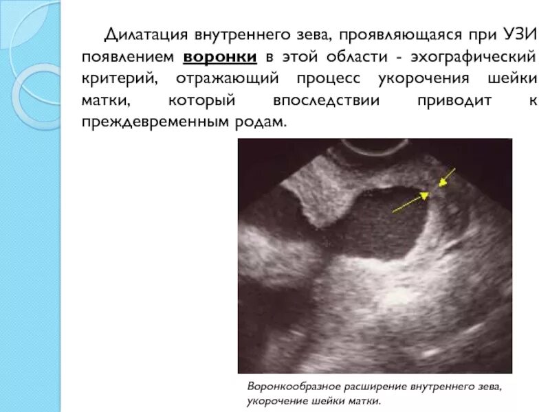 Истмико-цервикальная недостаточность на УЗИ. Воронкообразное расширение внутреннего зева УЗИ. ИЦН на УЗИ внутренний зев. Раскрытие внутреннего зева УЗИ. Шейка в 25 недель