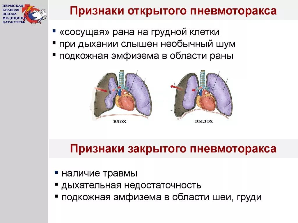 Признаки повреждения легких. Основные симптомы травмы грудной клетки. Клинические признаки пневмоторакса. Симптомы открытого пневмоторакса. Отличительный признак открытого пневмоторакса.