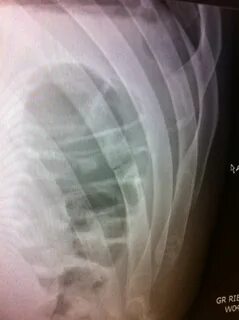 Broken ribs