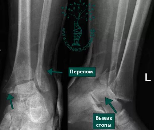 Перелом латеральной лодыжки. Перелом голеностопа с вывихом. Признаки перелома лодыжки.