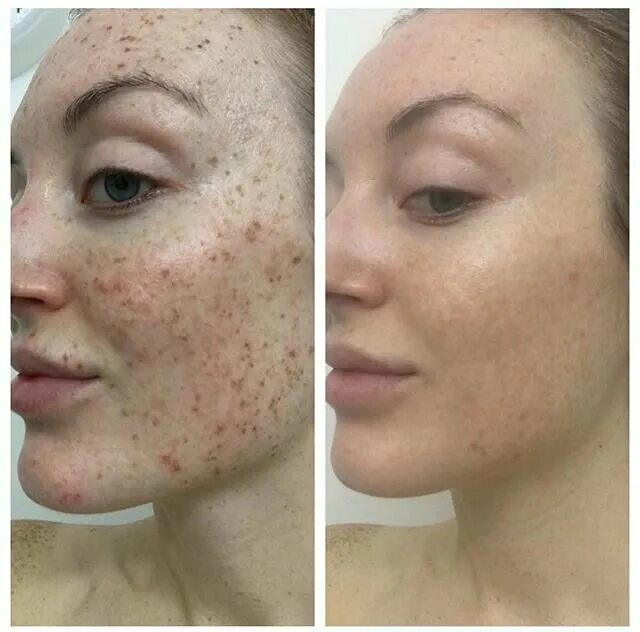 Лазерная шлифовка кожи цена skinlift ru. Лазерная наноперфорация постакне. Лазерная шлифовка постакне со2 реабилитация. Шлифовка со2 лазером постакне.