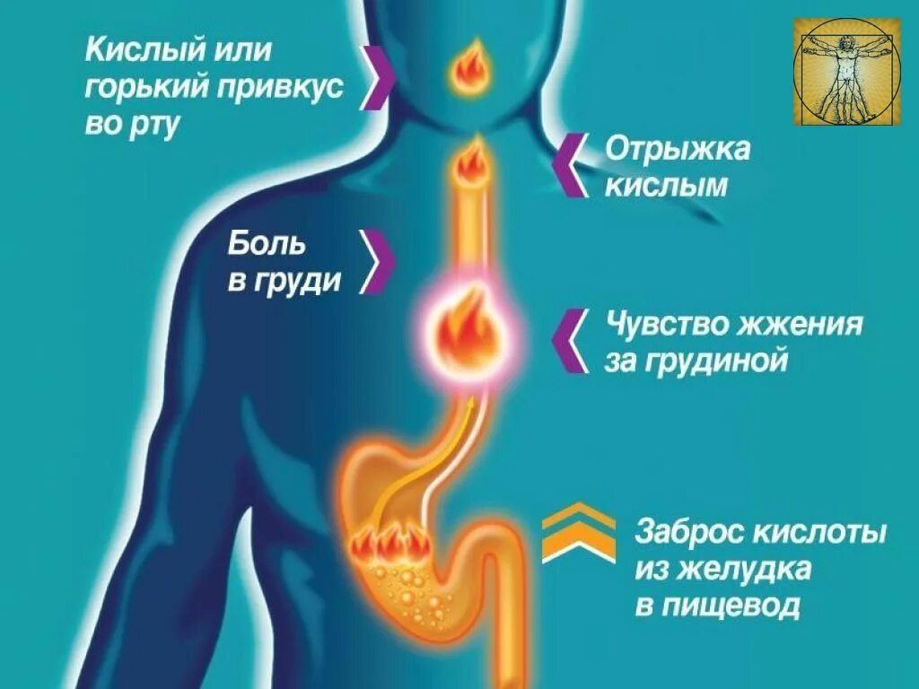 Симптомы изжоги желудка. Основные причины изжоги.