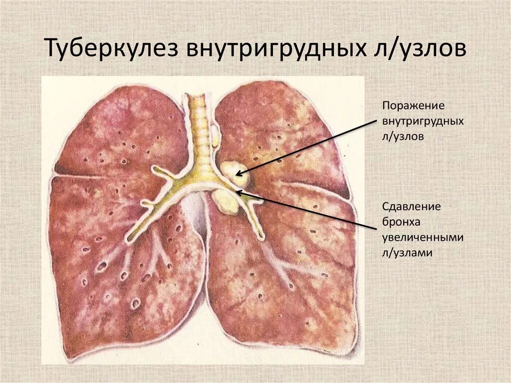 Узлы в легких что это. Симптомы туберкулез лимфатических внутригрудных. Внутригрудные лимфатические узлы туберкулез. Туберкулёз лимфатических узлов у детей. Формы туберкулеза внутригрудных лимфатических узлов.