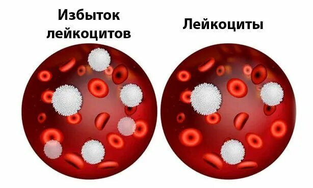 Лейкоцитарный лейкоцитоз. Лейкоцитоз в крови. Базофильный лейкоцитоз. Лейкоцитоз картинки.