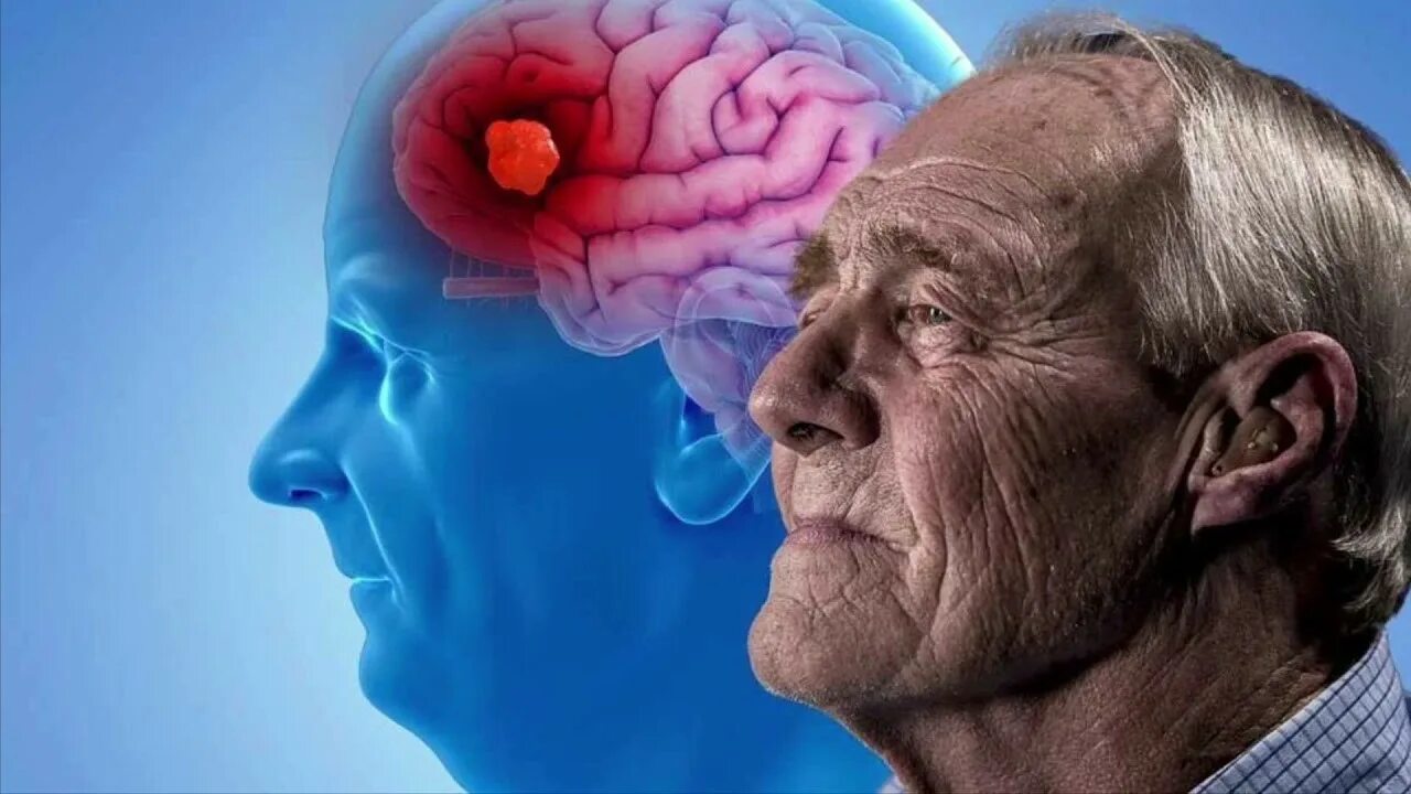 Мозг пожилого человека. Сосудистая деменция клиника. Инсульт альцгеймер. Хвороба альцгеймера. Пожилой мозг.