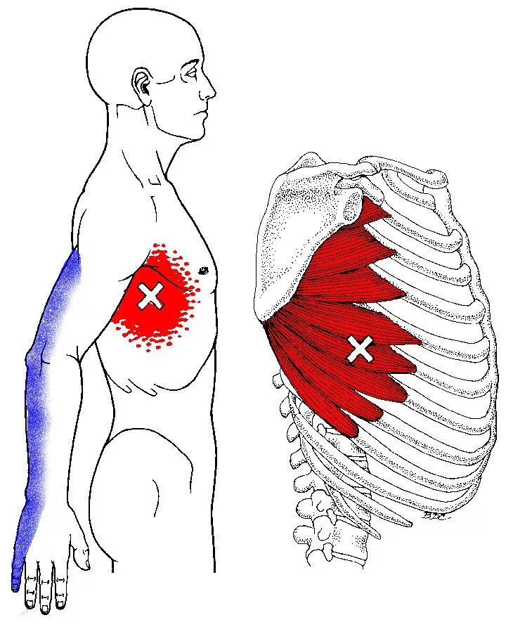 Колит под грудью с право. Триггерные точки грудной клетки. Триггерные точки мышцы грудной клетки. Болят ребра в грудной клетке.