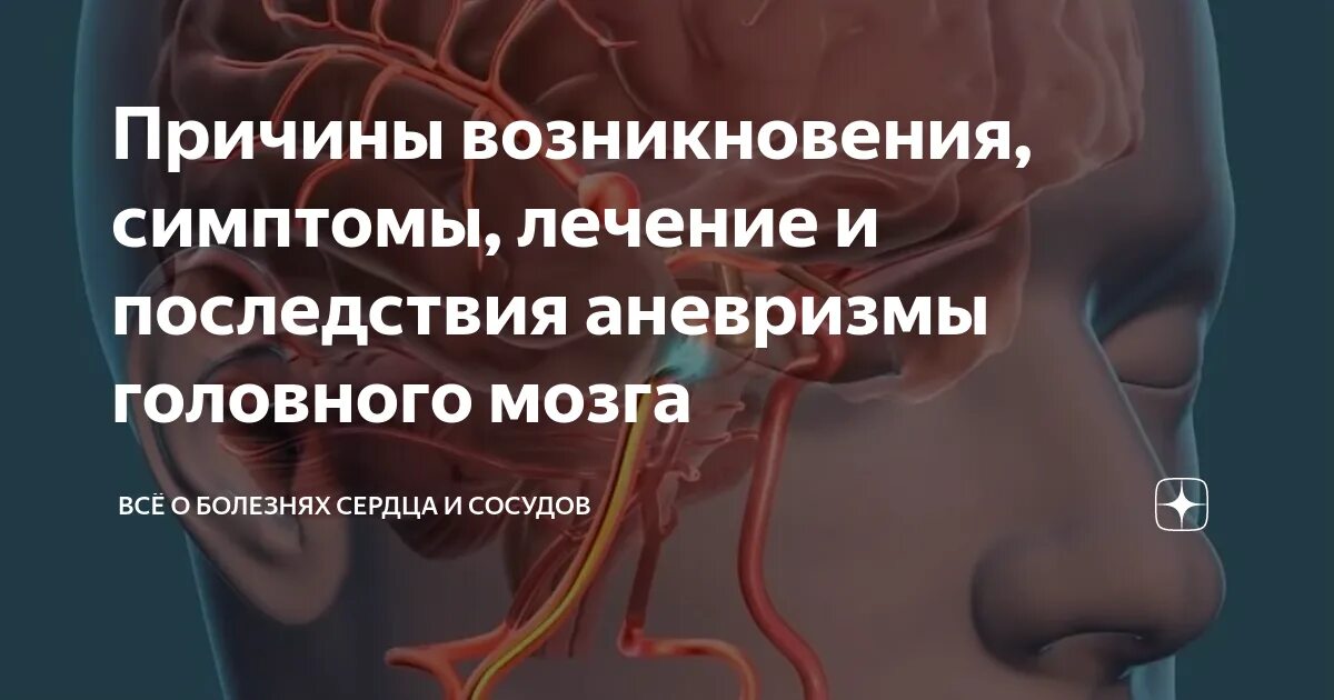 Симптомы аневризмы головного мозга. Аневризма сосудов головного мозга. Аневризма головного мозга симптомы. Аневризм сосудов головного мозга симптомы.