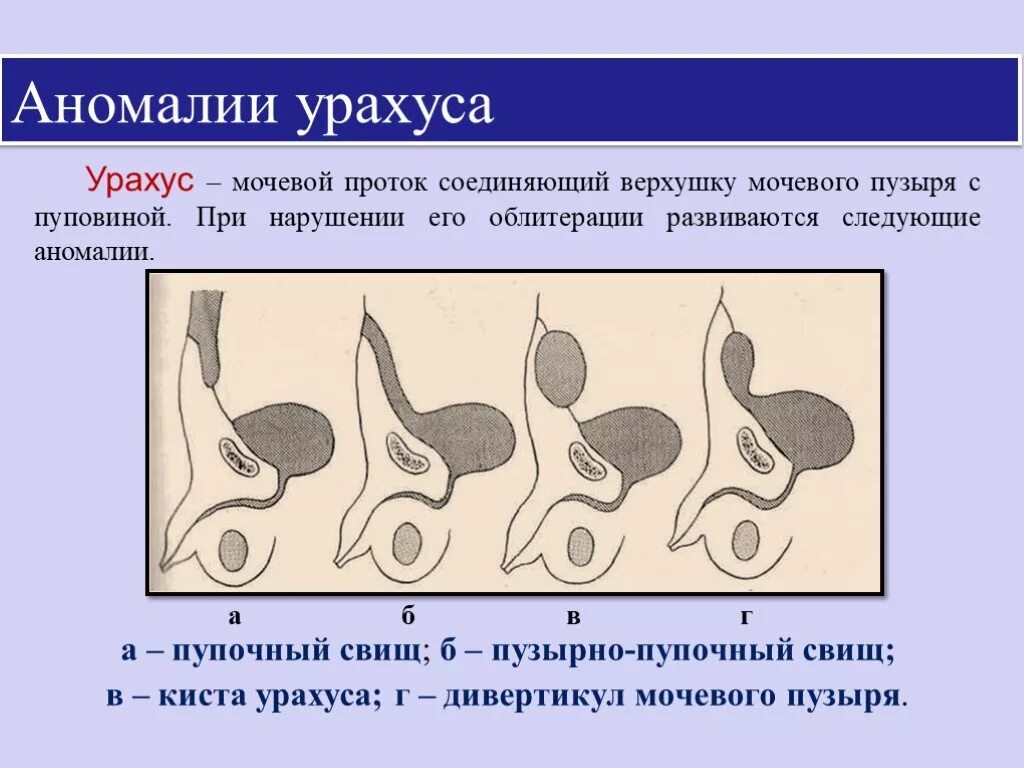 Пороки развития мочеполовых органов. Урахус гистология строение. Аномалии развития органов мочеполовой системы.