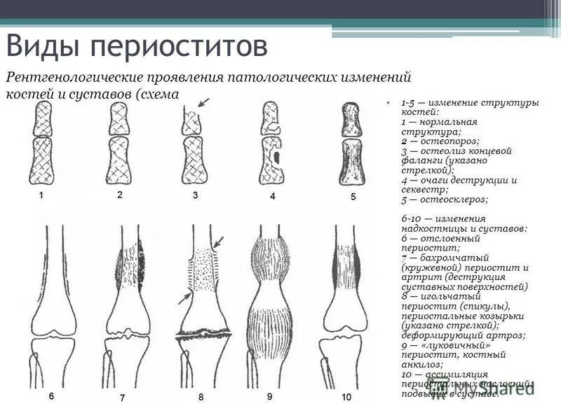 Изменение формы кости. Линейный периостит большеберцовой кости. Бахромчатый периостит рентгенограмма. Линейный периостит схема.