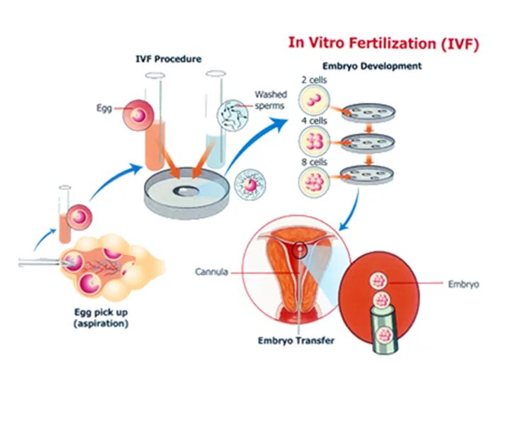 ИКСИ экстракорпоральное оплодотворение схема. Оплодотворение яйцеклетки in vitro. Схема экстракорпорального оплодотворения. Инсеминация in vitro.