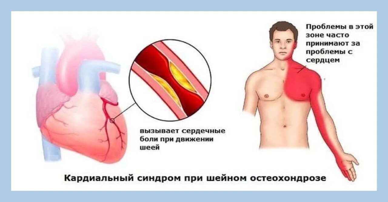 Как понять болят ли. Почему болит сердце. Отчего может болеть сердце. Сердечные боли. Кардиальный синдром при остеохондрозе.