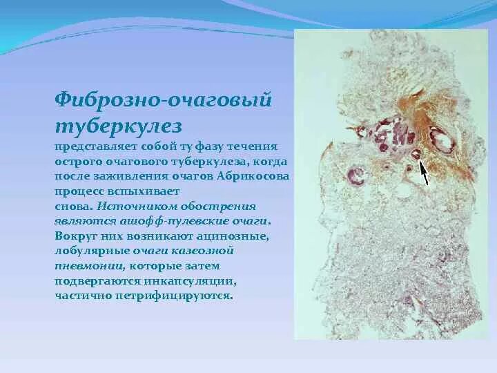 Очаг симон. Туберкулез очаг ашоффа пуля. фиброзно очаговый туберкулез. фиброзно-очаговый туберкулез легких. фиброзно очаговый туберкулез микропрепарат.