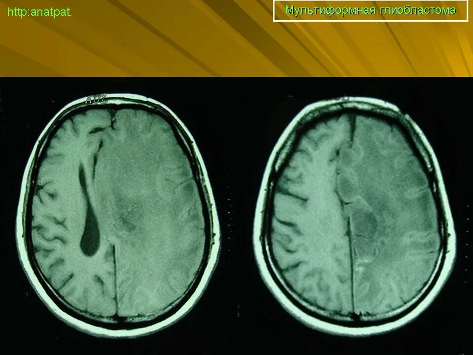 Глиобластома мозга симптомы. Мультиформная глиобластома. Глиобластома выживаемость. Десмопластическая глиобластома. Глиобластома изменение организма.