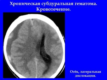 Латеральной гематомы