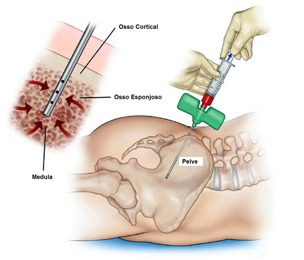 Костный мозг жидкость. Трепанобиопсия костного мозга. Техника проведения биопсии костного мозга.