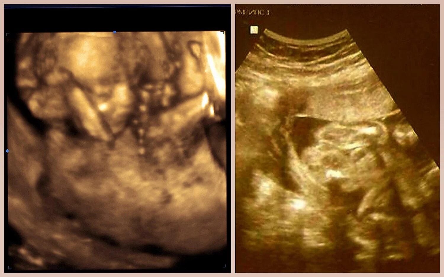 Плод ребенка на 17 неделе беременности. Ребенок в 17 недель фото. Ребенок в 17 недель фото. Ребёнок на 17 неделе беременности. Ребенок в 17 недель фото.