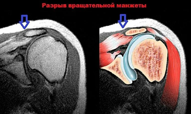 Разрыв вращательной манжеты плечевого сустава мрт. Ротаторная манжета плечевого сустава мрт. Повреждение ротаторной манжеты мрт. Разрыв вращательной манжеты плечевого сустава рентген. Повреждения правого плечевого сустава